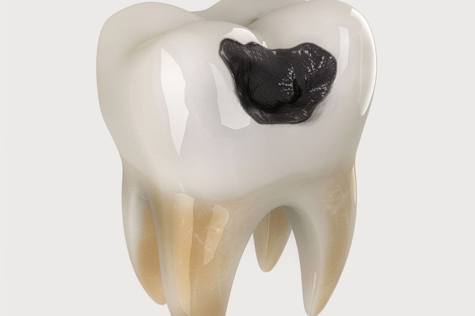 A white tooth with a small spot of decay on the top